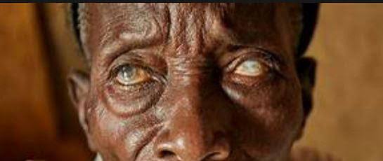 River Blindness Threatens Rural Communities: What Nigerians Need to Know